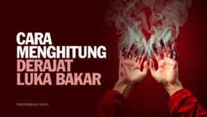 Cara Menghitung Derajat Luka Bakar